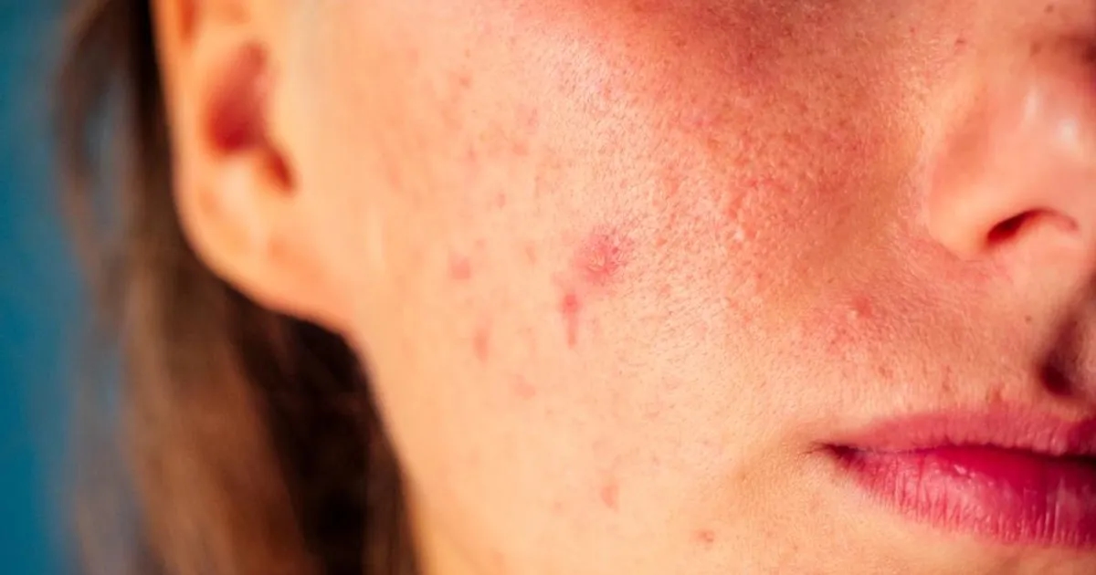 Pryszcz który nie znika: co oznacza i kiedy iść do dermatologa