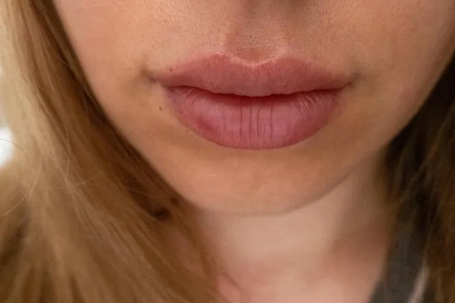 Czy kwas hialuronowy może się przemieszczyć? Przyczyny i skutki migracji