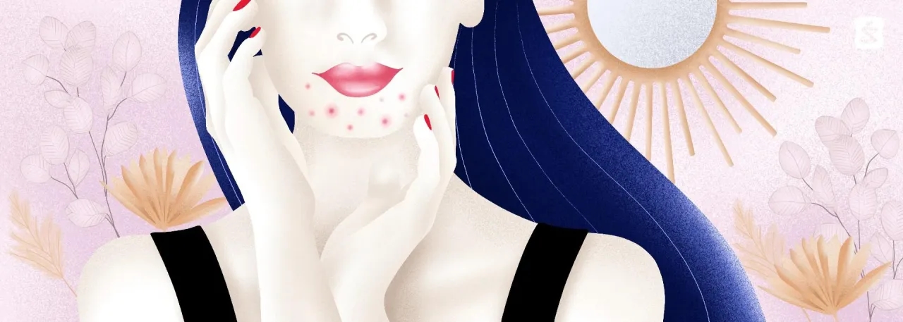 Jak pozbyć się pryszczy na brodzie - skuteczne sposoby i porady