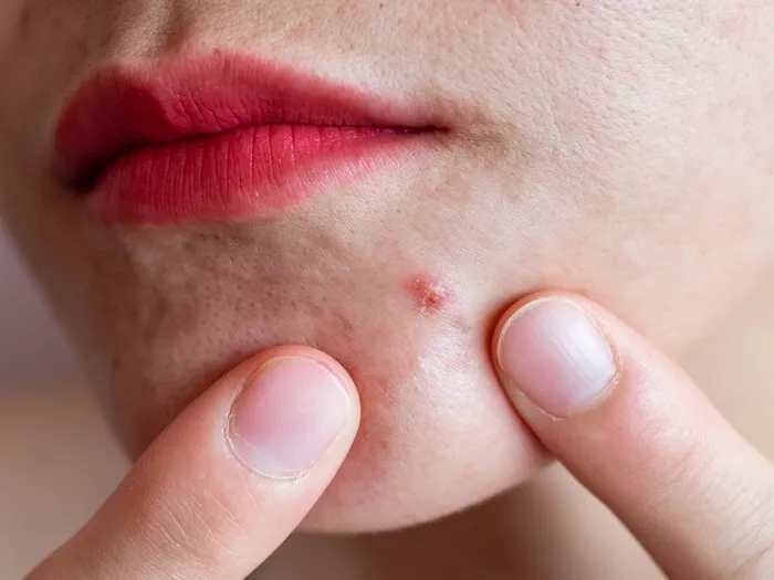 Co oznaczają pryszcze na brodzie i jak je skutecznie zwalczyć