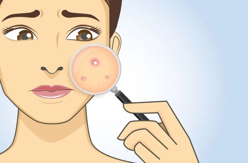 Ile trzymać maść ichtiolową na pryszczu, aby uniknąć blizn?