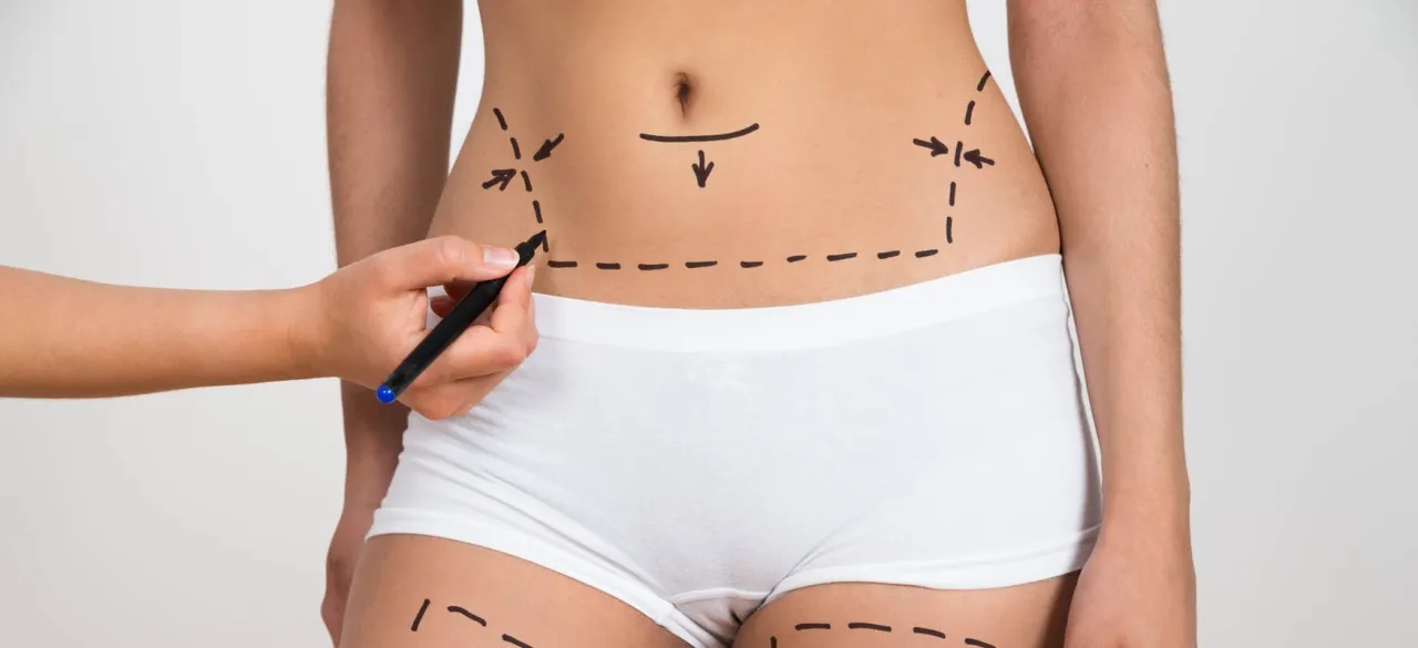 Liposukcja kawitacyjna - kiedy zobaczysz efekty zabiegu?