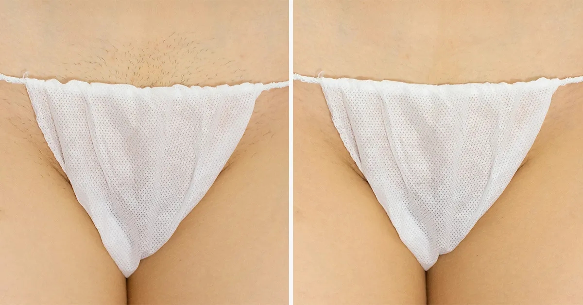 Ile zabiegów laserem na bikini potrzebujesz dla trwałych efektów?