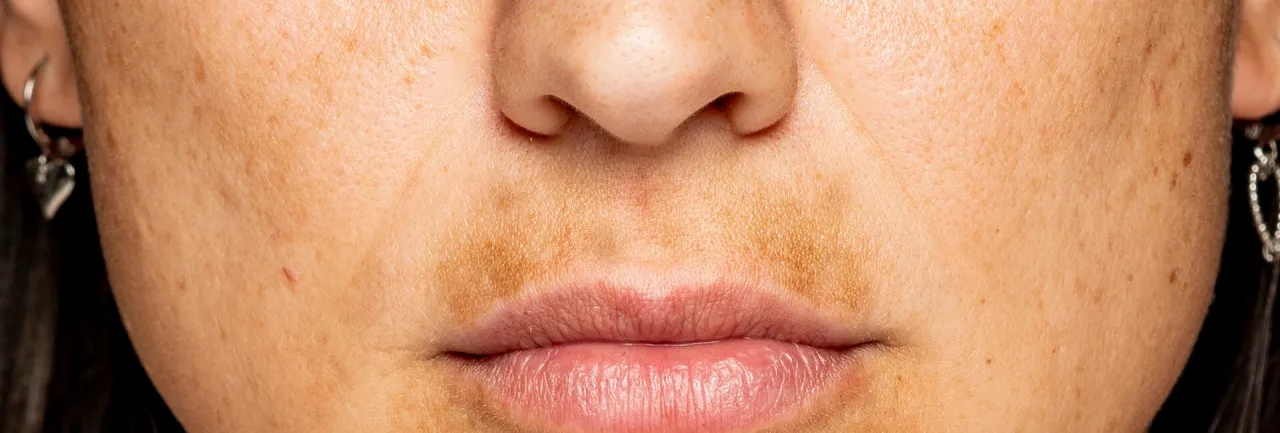 Gdzie nie wyciskać pryszczy? Unikaj tych niebezpiecznych miejsc