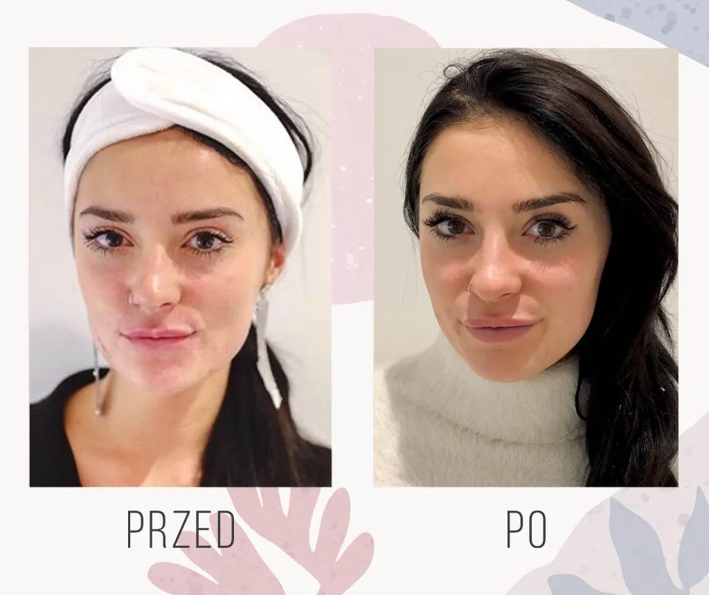 Po jakim czasie widać efekty kwasu hialuronowego? Oczekuj zaskoczenia!