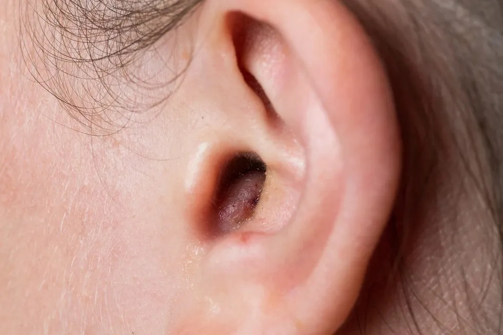Jak skutecznie pozbyć się pryszcza w uchu i uniknąć bólu