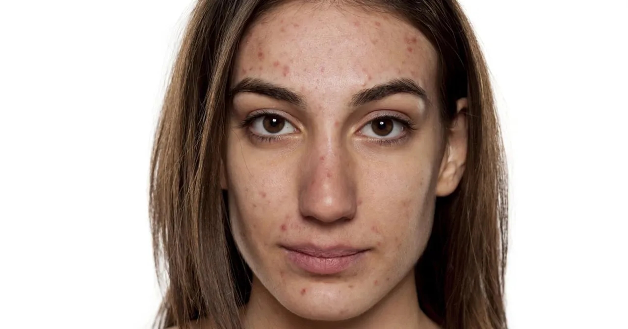 Skuteczne sposoby na przebarwienia po pryszczach, które działają
