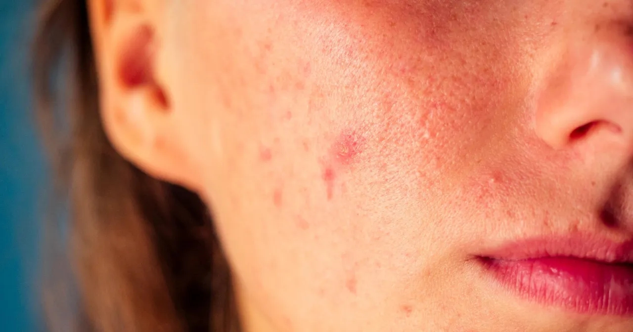 Skąd się biorą pryszcze? Oto przyczyny, które musisz znać