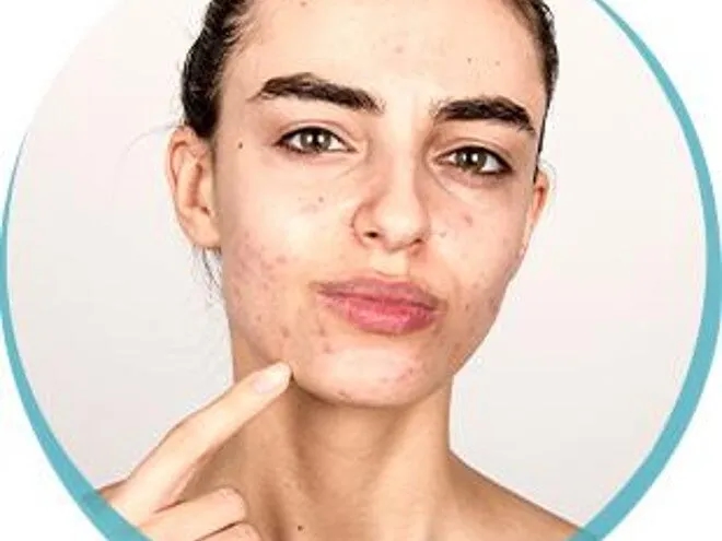 Pryszcze objawy ciąży: Jak hormonalne zmiany wpływają na skórę