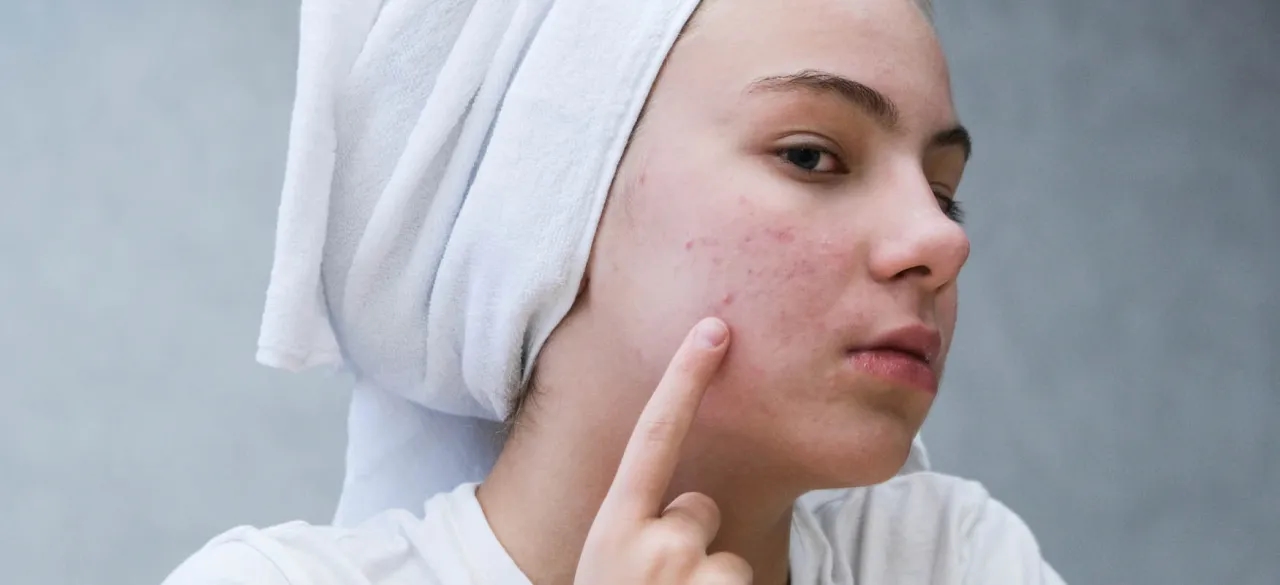 Jak usunąć pryszcza pod skórą bez ryzyka blizn i infekcji