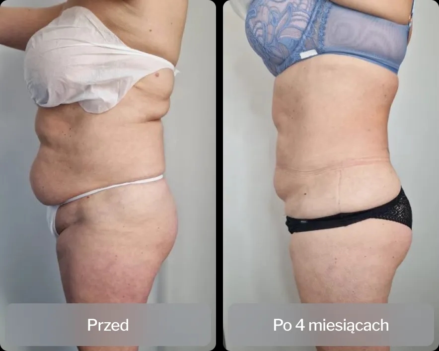 Liposukcja ultradźwiękowa co to? Fakty, które musisz znać przed zabiegiem