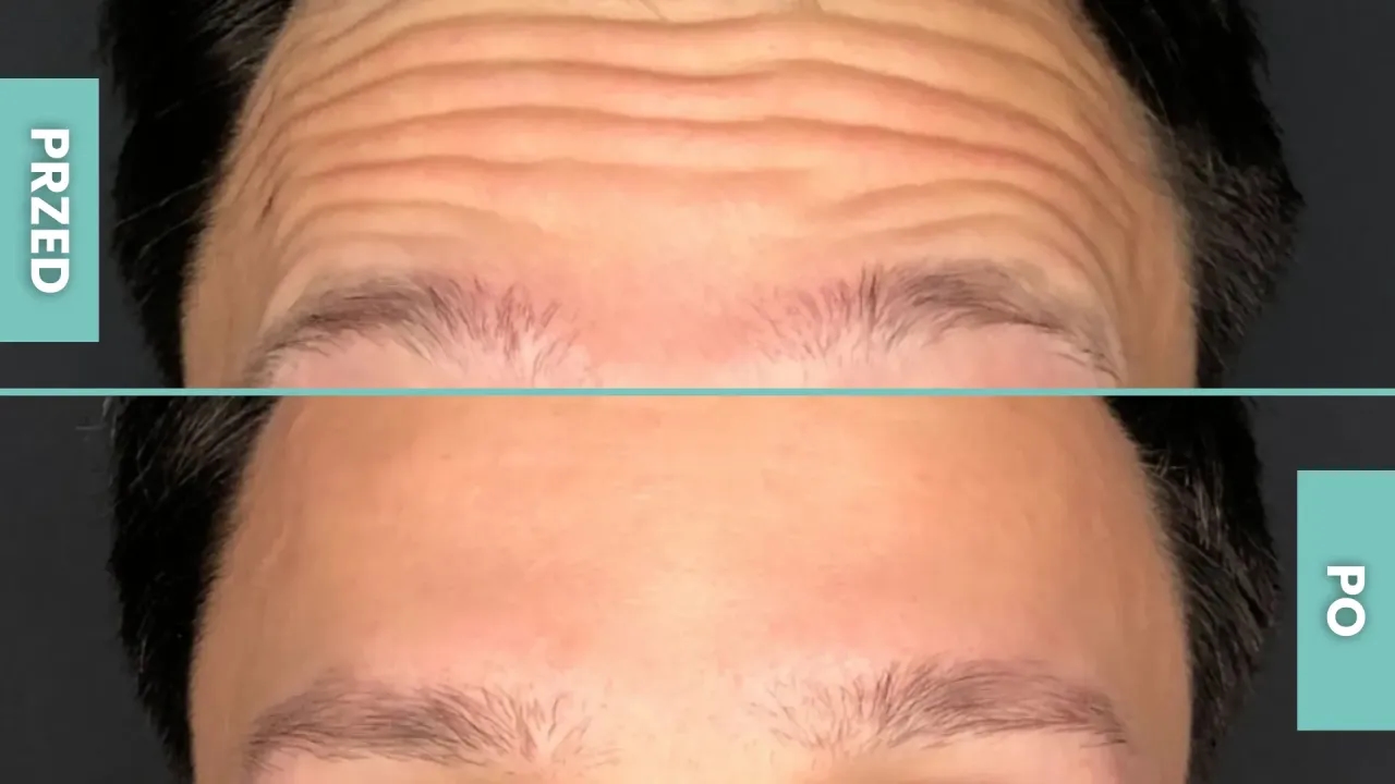 Botoks czy kwas na czoło: co wybrać dla wygładzenia zmarszczek?