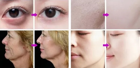 Oczyszczanie wodorowe czy mikrodermabrazja – która metoda jest lepsza?