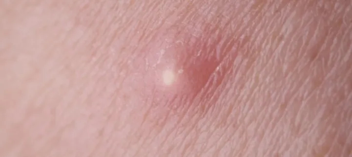 Czyrak czy pryszcz: jak je odróżnić i skutecznie leczyć?