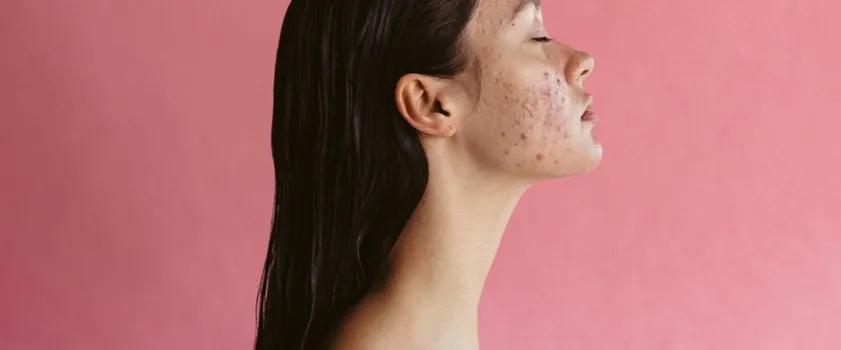 Szybkie sposoby na pozbycie się zaczerwienienia po pryszczach