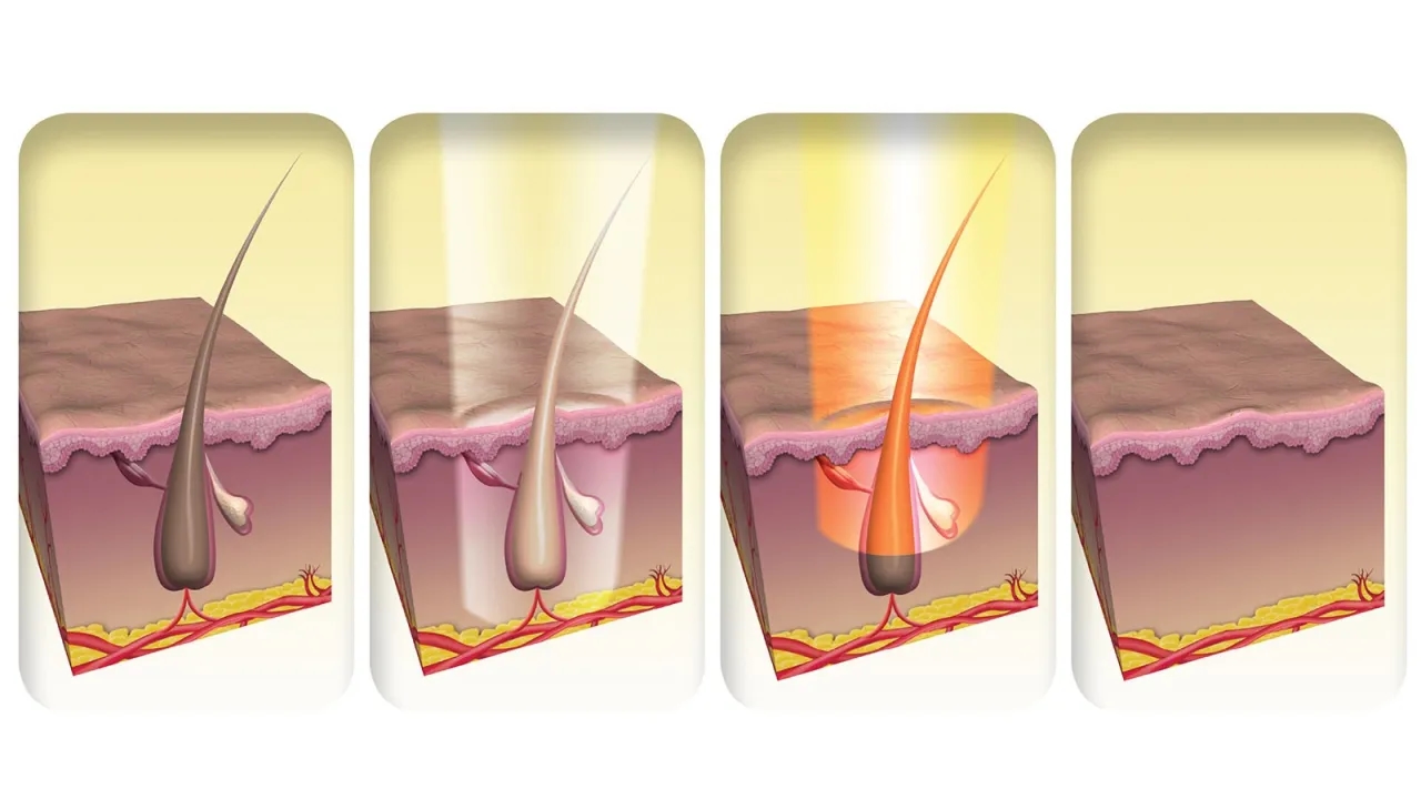 Jak działa depilator laserowy? Odkryj skuteczność i różnice