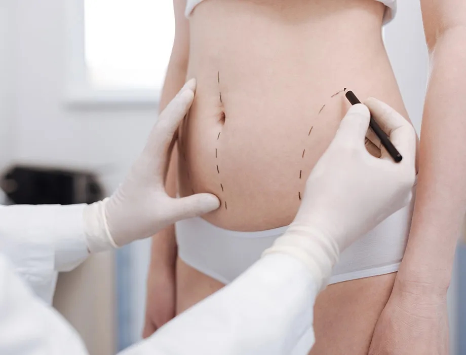 Lipoliza czy liposukcja – która metoda skuteczniej redukuje tłuszcz?