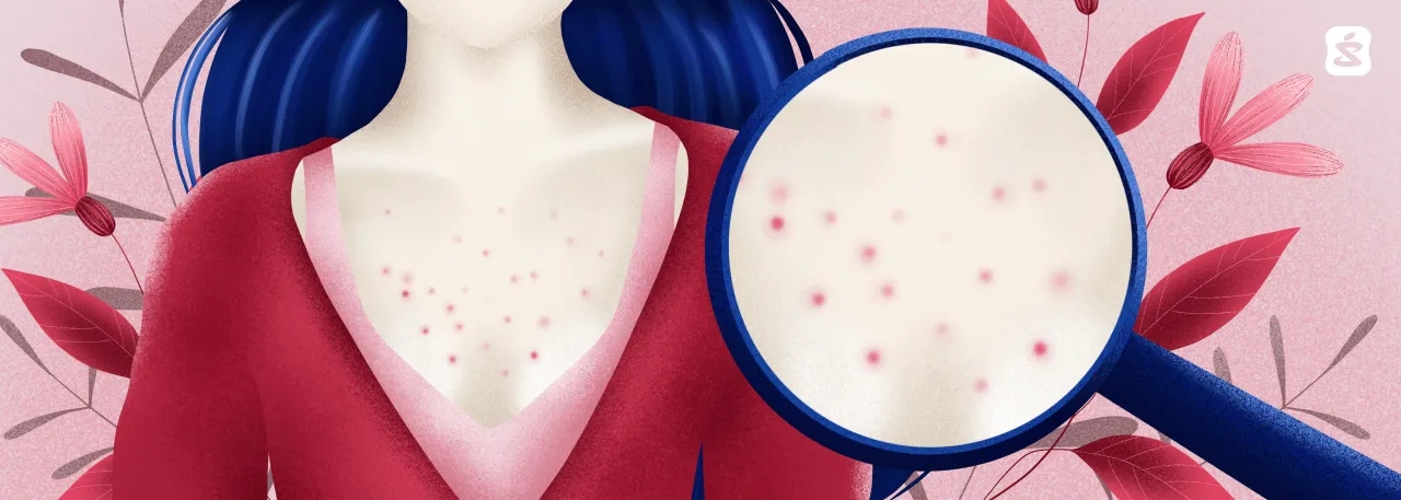 Skuteczne sposoby na to, jak pozbyć się pryszczy na dekolcie