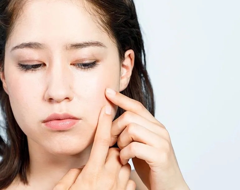 Czy pryszcze same znikają? Sprawdź, kiedy potrzebna jest pomoc dermatologa