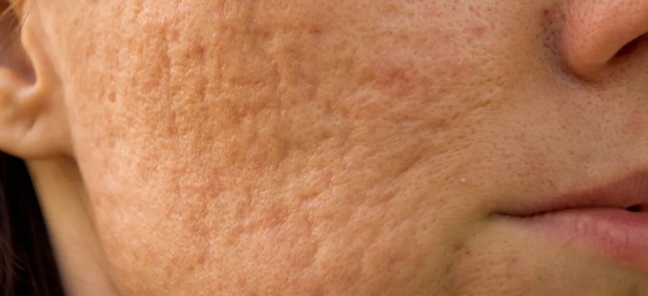 Jak pozbyć się śladów po pryszczach – skuteczne metody i porady